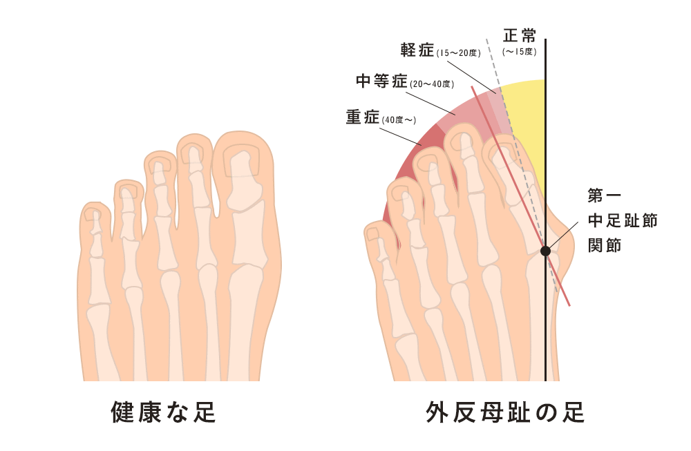 外反母趾とは？